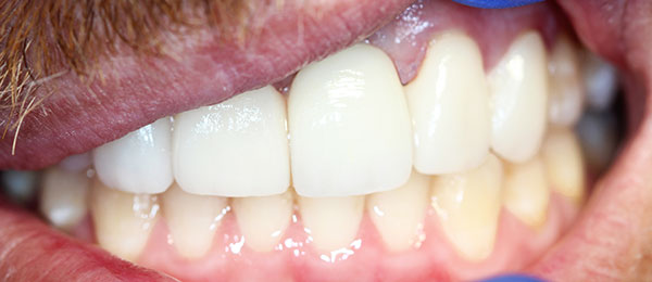 Case 1 after