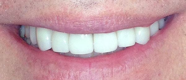 Case 4 after