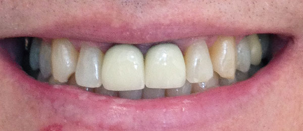 Case 4 before